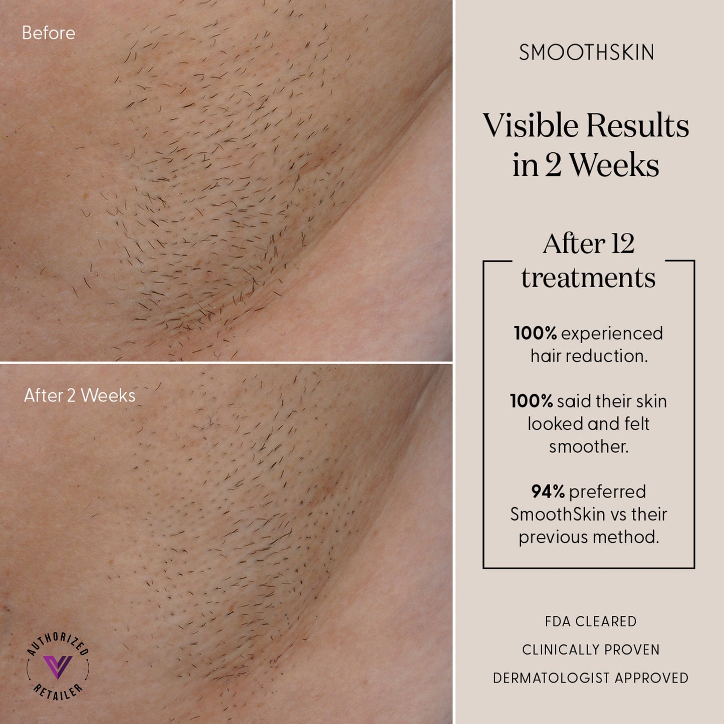 SmoothSkin Pure Adapt - Powerful IPL Hair Removal Device Smoothskin
