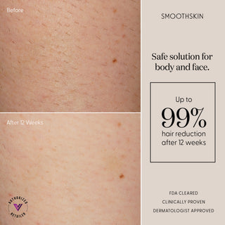 Laser Hair Removal Device Smoothskin